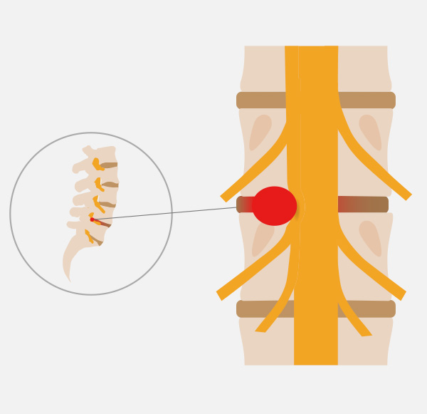 La sciatique par hernie discale Toulouse - Unité de Pathologies ...